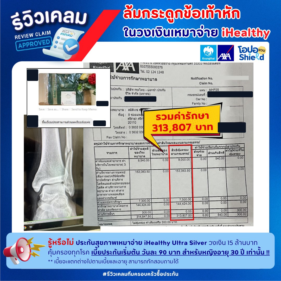 รูปรีวิวเคลม ล้มแล้วกระดูกข้อเท้าหัก ต้องผ่าตัดและนอนโรงพยาบาล 3 วัน (ปิดชื่อลูกค้าแล้ว)