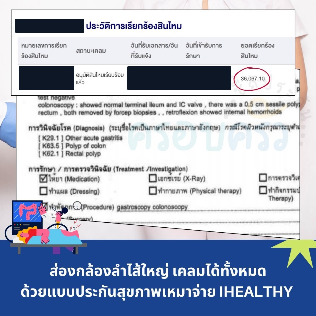 รูปรีวิวเคลม ส่องกล้องกระเพาะอาหารและลำไส้ใหญ่ พบกระเพาะอักเสบเฉียบพลัน ติ่งเนื้อลำไส้ และริดสีดวงภายใน (ปิดชื่อลูกค้าแล้ว)